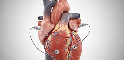 kardiale resynchronisationstherapie (CRT)