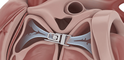 transkatheter aortenklappen implantation (TAVI)